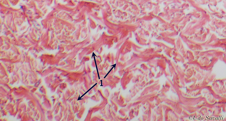 dense irregular CT