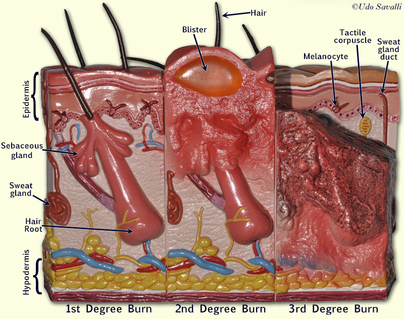 Skin model with burns labeled